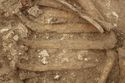 Thumbnail of Photo 10392 Skeleton 606044 pathologies no scale
