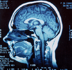 IMAGE: Magnetic resonance (MR) 'slice' from the scan of a head