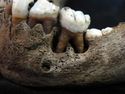 Thumbnail of Bone destruction at the base of the tooth roots and porous new bone formation caused by infection from a dental abscess in a child’s mandible. Copyright AOC Archaeology