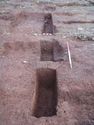 Thumbnail of Post-ex view of PT [1521] 