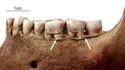 Thumbnail of Figure 6.20: Bainesse Cemetery: Skeleton 13111 (Grave 208), periodontal disease on left mandible
