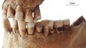 Thumbnail of Figure 6.29: Bainesse Cemetery: Skeleton 12580 (Grave 154), activity-related wear of the left mandibular first molar and second premolar.